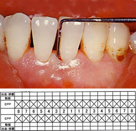 歯周組織検査