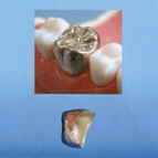 銀歯（金銀パラジウム合金）