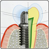 インプラント